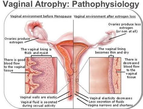 womens health genitourinary syndrome of menopause