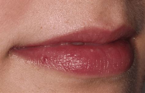 lip fillers liverpool full plump and natural lips from just £220