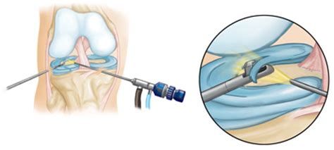 arthroscopic surgery singapore sports orthopaedics clinic