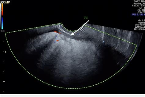 Transvaginal Pelvic Ultrasound Image With Colour Doppler Revealing A