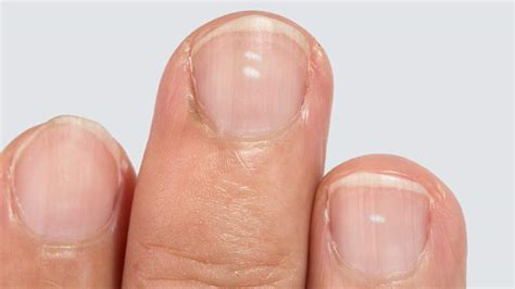 what the white spots on your fingernails reveal about your health
