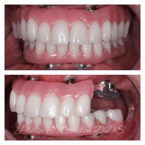 broken  failing dental implants gordon dental implants cosmetics