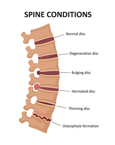 herniated disc causes symptoms and treatment · dunbar medical