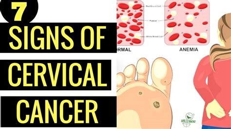 Warning Women Never Ignore These 7 Signs Of Cervical Cancer Healingplus