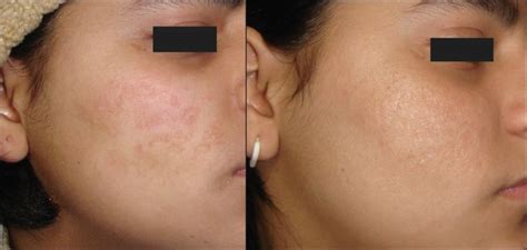 pin  aculift derma roller acne scars