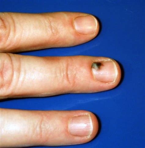 subungual hematoma black bruised fingernail drainage and treatment
