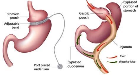 Converting A Gastric Band To A Laparoscopic Gastric Bypass