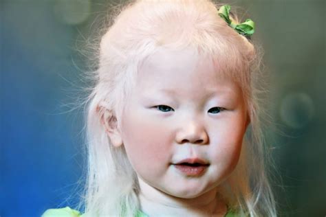 albinism strive  good health