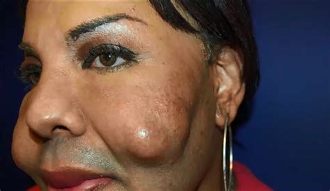 botched transgender woman s face exploded after having cement injected