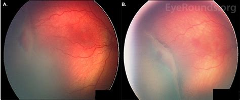 retinopathy  prematurity