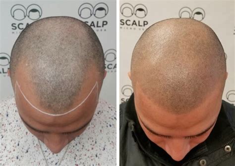 bald men  tattooing  scalps  give  illusion   hair