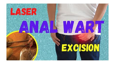Laser Treatment Of Anal Warts How Can I Remove A Wart Youtube