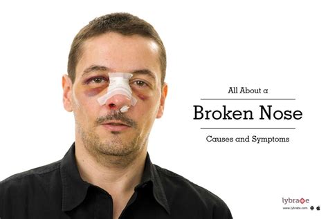 broken nose   symptoms  dr shalabh sharma