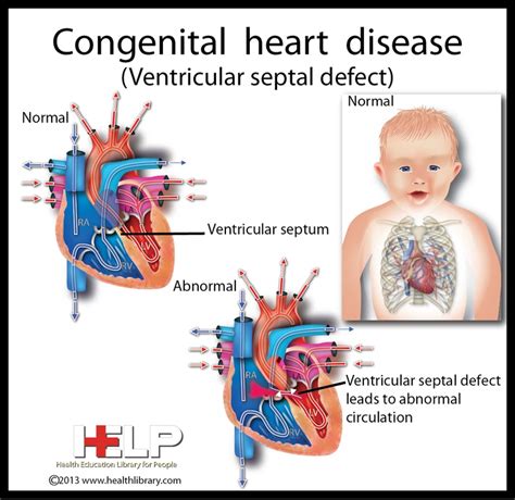 congenital   congenital heart defect