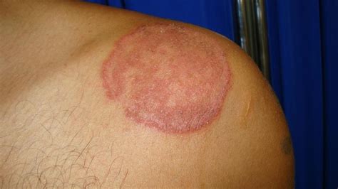 ringworm images pictures