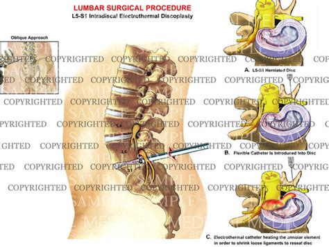 l5 s1 intradiscal electrothermal discoplasty — medical art works