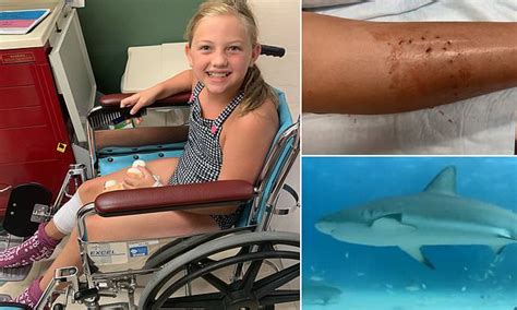 Girl 9 Is Bitten By Shark At Florida Beach Dubbed The Shark Bite