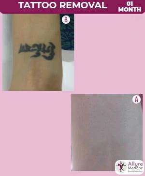 aggregate  laser tattoo removal   sessions latest incdgdbentre