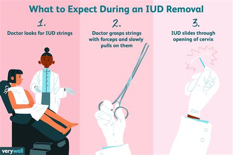 expect   iud removal