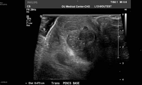 penile fracture following a fall in a 7 year old male