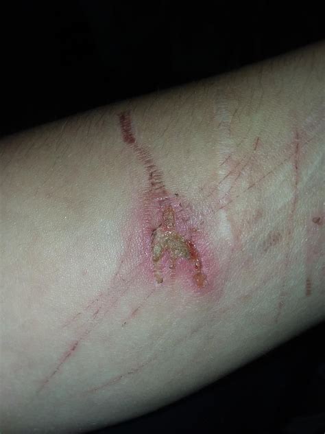 day  burn  infected medical