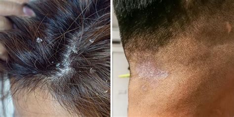 Seborrheic Dermatitis And Hair Loss All You Need To Know