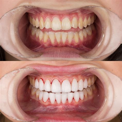 pictures dentaglobal dental implants cosmetic