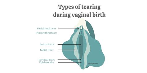 types  tearing   occur  childbirth lady bird pt