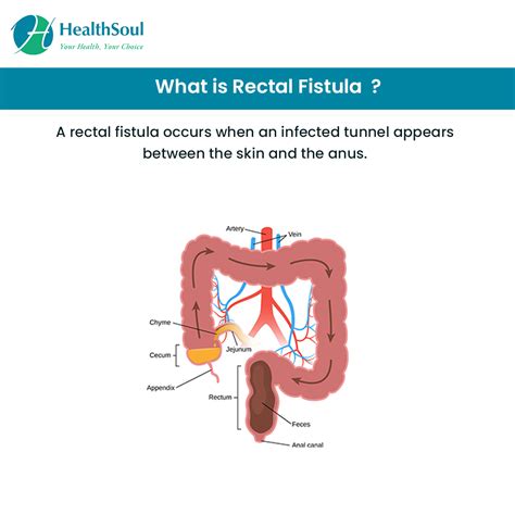 rectal fistula symptoms diagnosis  treatment healthsoul