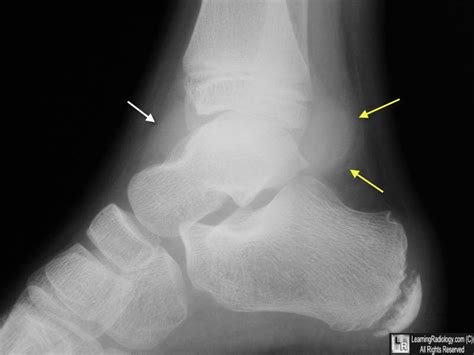 learning radiology ankle joint effusion