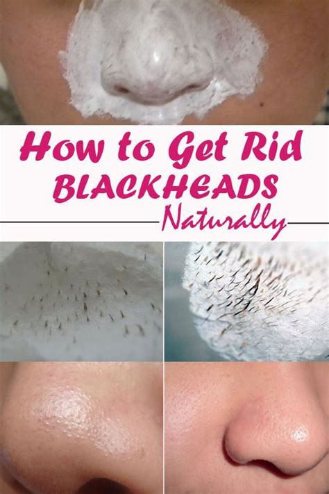 how to get rid of blackheads naturally remedies