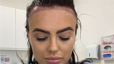 Love Island’s Rosie Williams Reveals Results Of Hair Transplant After