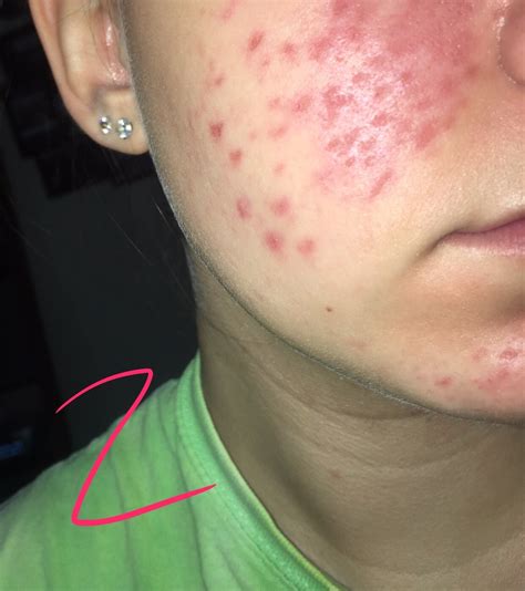 inflamed dehydrated pores dermatillomania rosacea facial redness acneorg