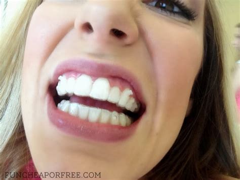 Why I Got Invisalign As An Adult And How It S Going Fun Cheap Or Free