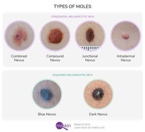 Moles Nevi Guide Types And Pictures Of Normal Healthy Moles