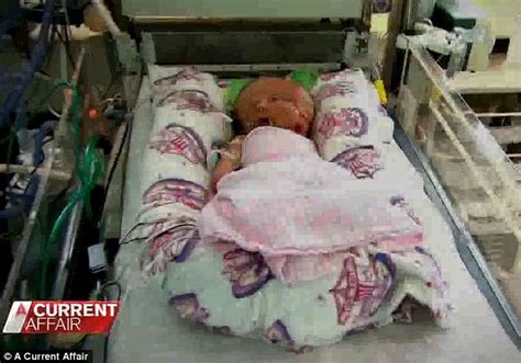 incredible woman gives birth to conjoined twins who share a body but