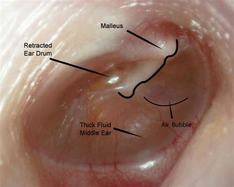 middle ear conditions anatomy poster   grommets vrogueco