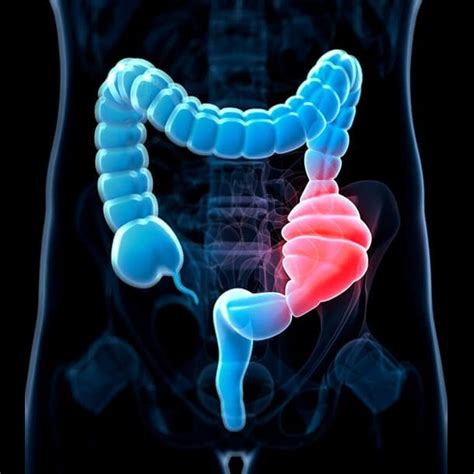 colon cancer symptoms signs screening stages