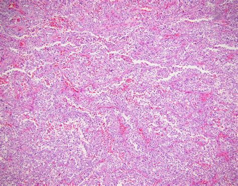 neuropathology blog choroid plexus carcinoma   infant