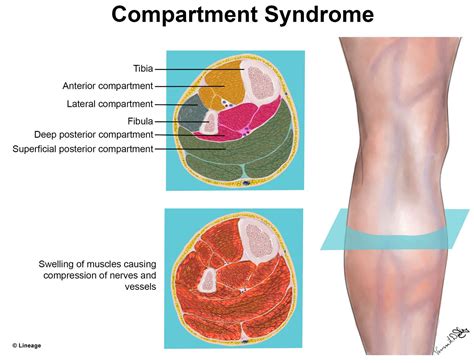 compartment syndrome orthopedics medbullets step