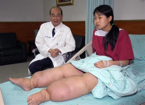 what is scrotal elephantiasis kenyan man has surgery after 11 pound testicles left him barely