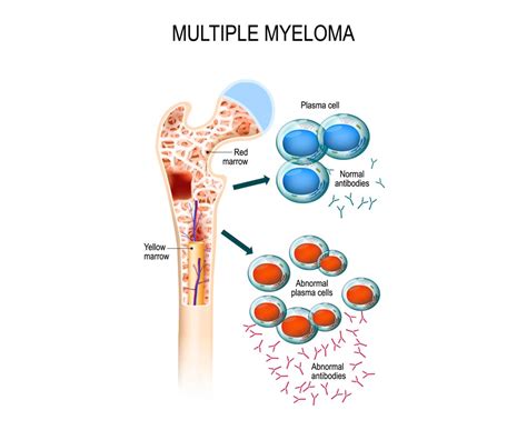 multiple myeloma diagtec preclinical cro  mm lymphoma leukemia