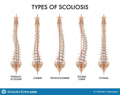 Vertebral Spine Escoliosis Colonne Columna Scoliosis Vertebrale Spinal