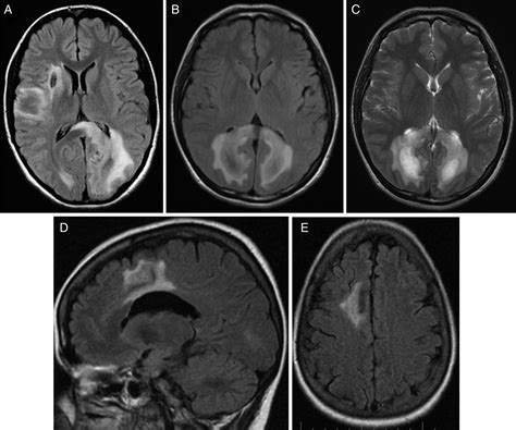 The Corpus Callosum In The Diagnosis Of Multiple Sclerosis And Other