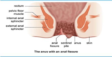 Symptoms anal fissures