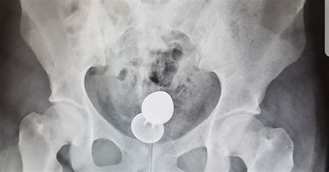 sex toy butt plug x ray stuck in bowels story removal