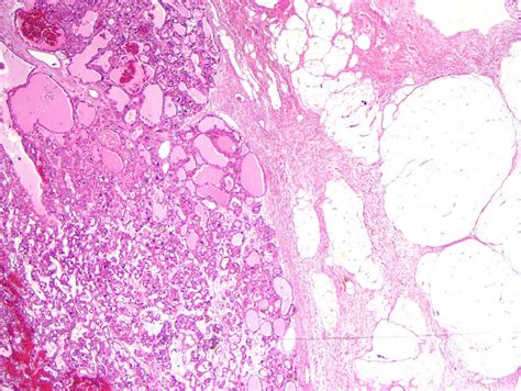 week 654 case 2 johns hopkins surgical pathology unknown conference