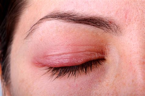 inflammation  eyelid