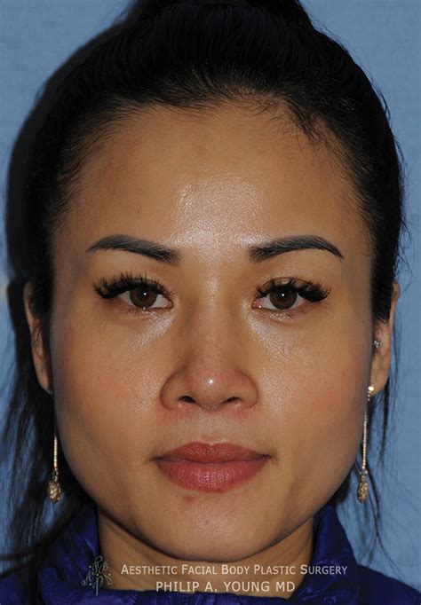 asian rhinoplasty before and after photos seattle bellevue