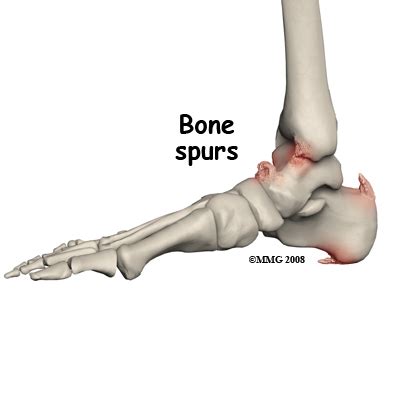 bone spur  osteophyte bone  spine